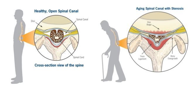 علائم تنگی کانال نخاعی یا Spinal Stenosis