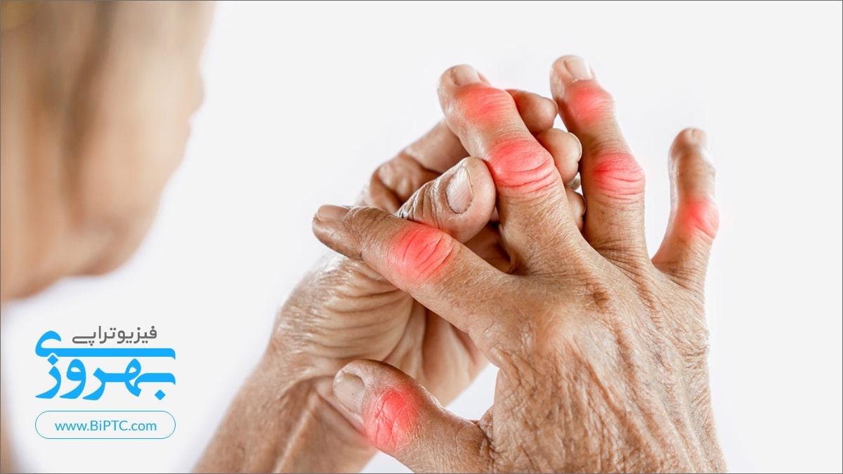 علائم رماتیسم مفصلی